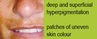 Hyperpigmented1